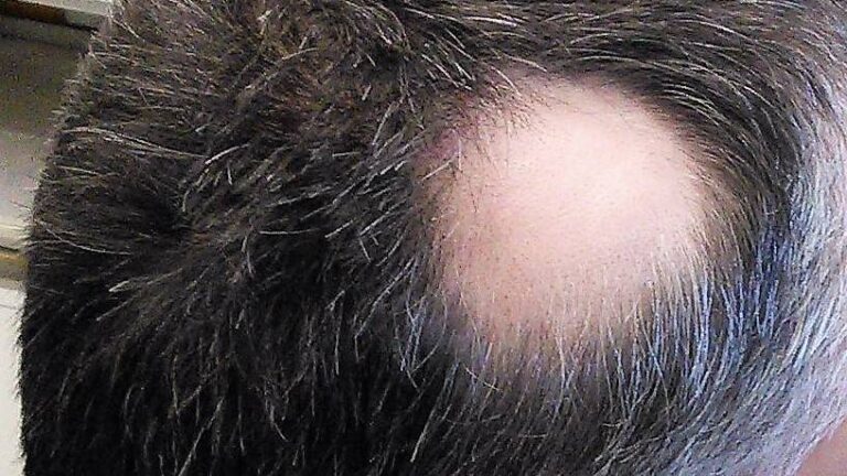 anvisa-aprova-novo-remedio-para-tratamento-de-doenca-que-causa-queda-de-cabelo-cronica